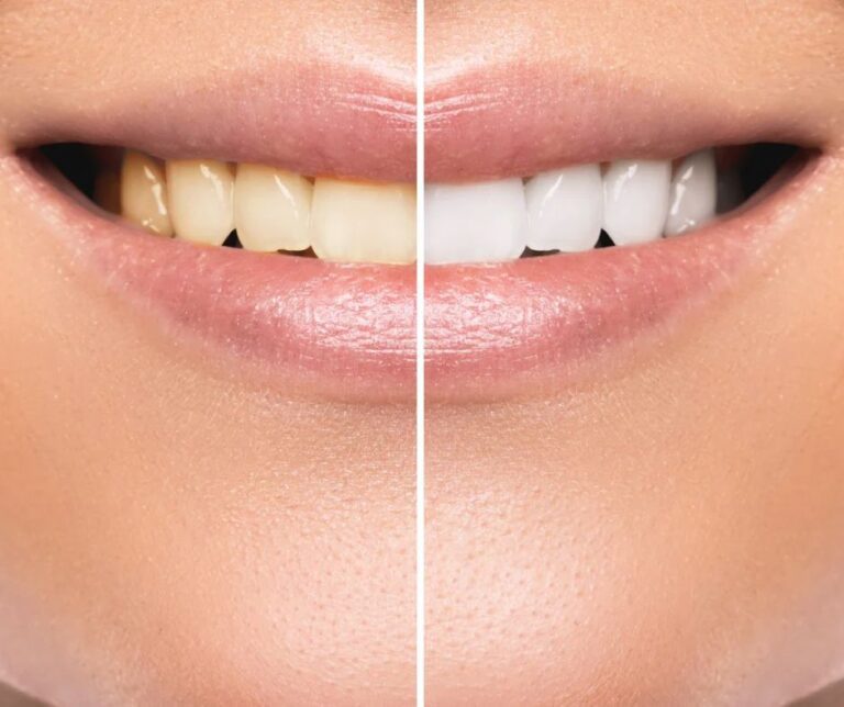 Teeth Whitening and Scaling in Patna