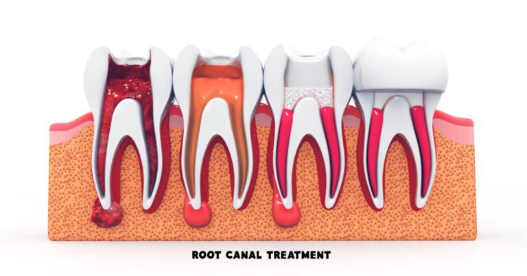 Root Canal Treatment in Patna