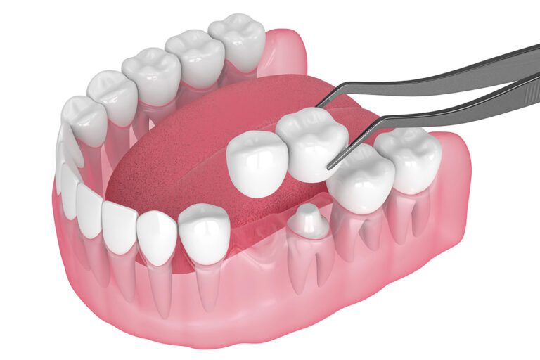 Zeconia Crown And Dental Bridges in Patna